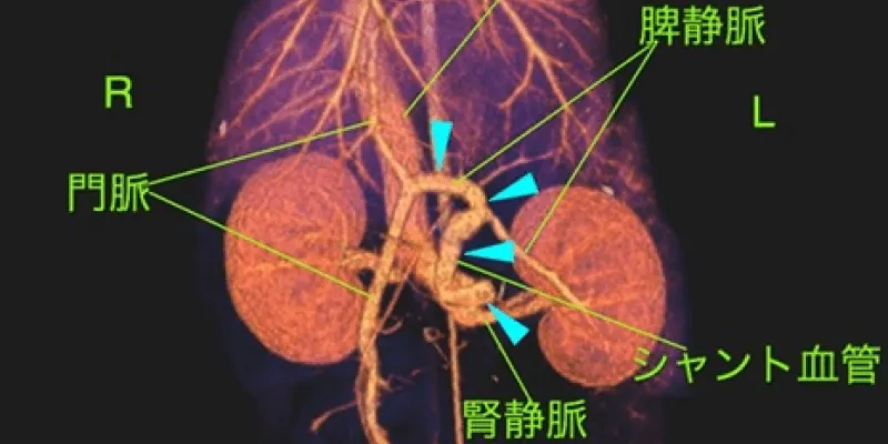 先天性門脈体循環シャントイメージ
